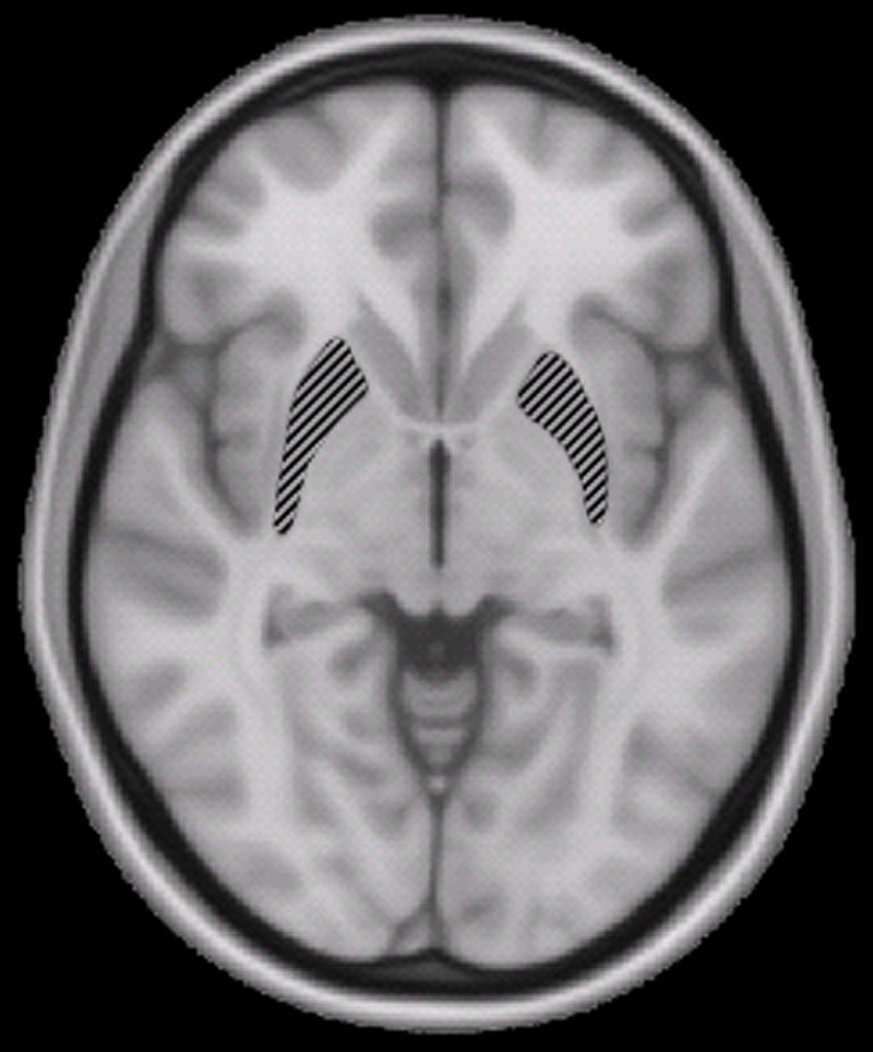 Bild på hjärna. Foto: Wikimedia